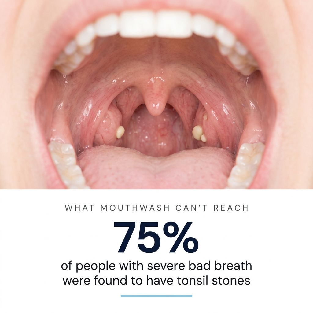 Tonsil Stone Kit
