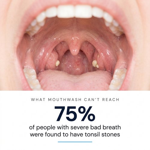 Tonsil Stone Kit